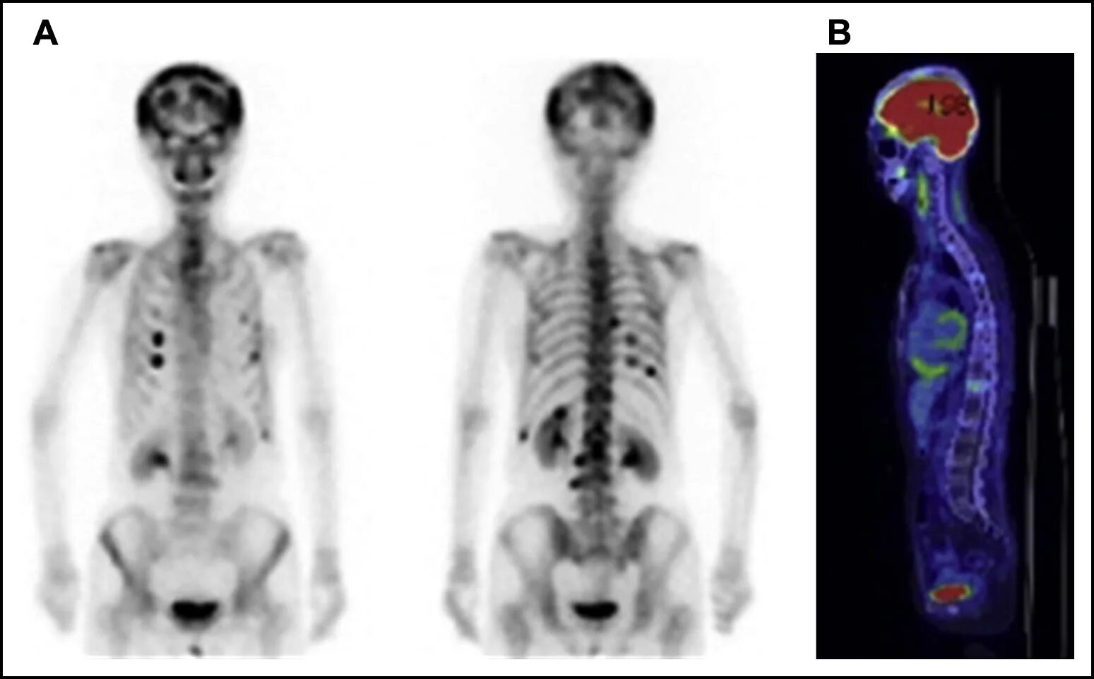 Метастатическое поражение кости. Сцинтиграфия скелета метастазы. Сцинтиграфия костей метастазы. Сцинтиграфия метастазы в кости. Остеосцинтиграфия метастазы.