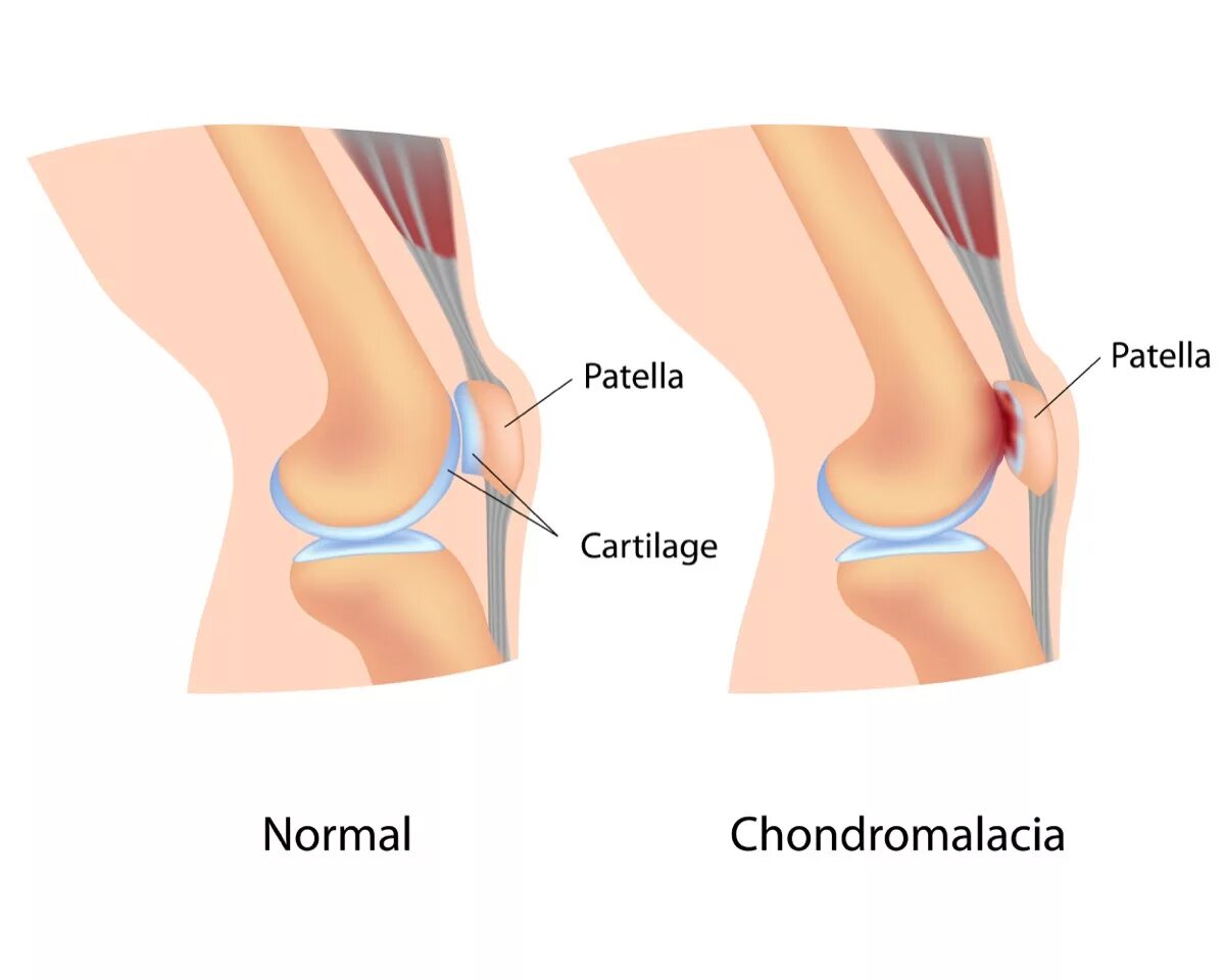 Хондромаляция медиальных мыщелков бедренной кости. Хондромаляция коленного сустава 1 степени. Хондромаляция надколенника 4. Хондромаляция суставного хряща степени. Хондромаляция надколенника надколенника.