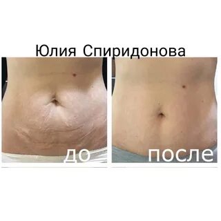 Массаж живота до и после