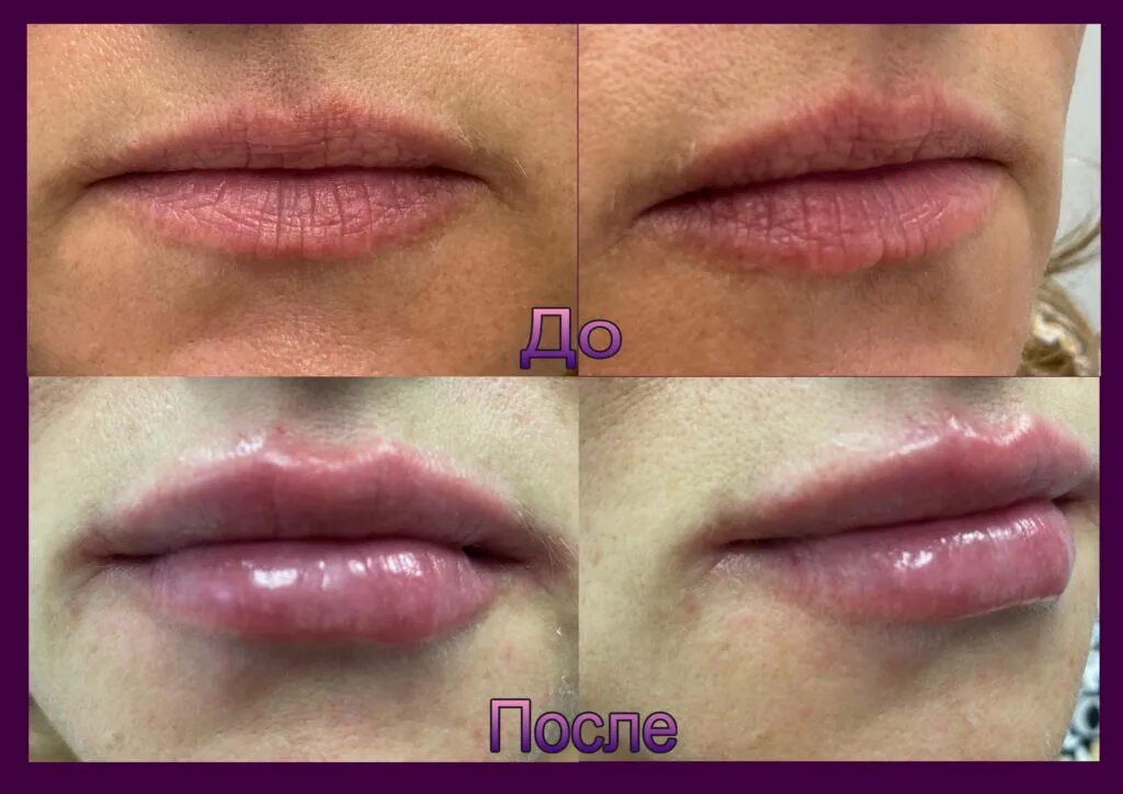 Мигрирование филлера в губах. Как понять что губы мигрируют. Контур губ гиалуроновой гиалуроновой кислотой. Мишрафия филлера в губах. Гиалуроновые усы после увеличение губ.