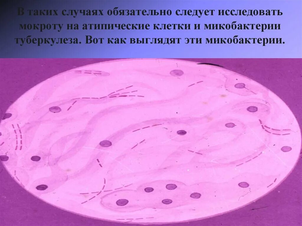 Мокрота на атипичные клетки алгоритм. Атипичные клетки в мокроте. мокрота на атипические клетки алгоритм. атипичная клетка в мокроте.
