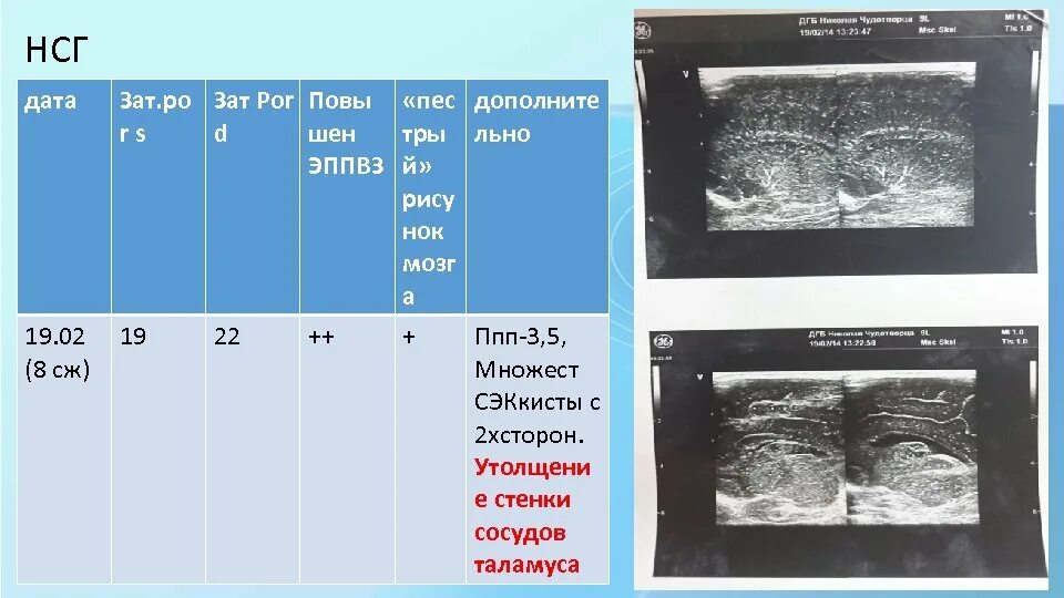 Нормы нсг. Нейросонография УЗИ. НСГ норма. В НСГ ППП. Нейросонография новорожденных.