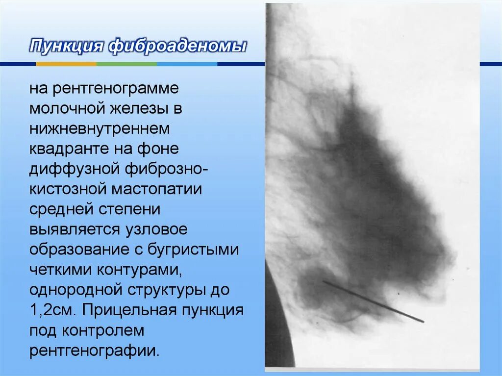 Мастопатия молочной железы рентгенограмма. Диффузионная фиброзно-кистозная мастопатия. Фиброаденома молочной железы 1б. Мастопатия молочной железы маммограмма. Диффузно узловое образование