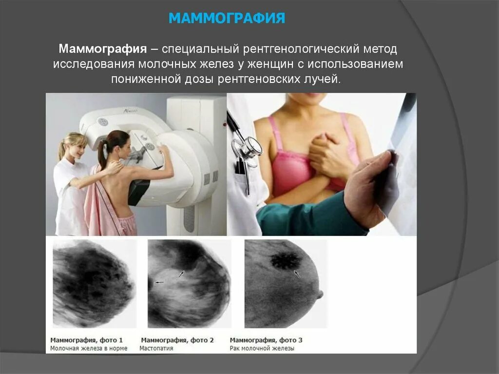 Маммография молочной железы м1 м2. Маммография молочных желез РМЖ. Исследование молочный желез. Рик молочной железы маммографич. Рак молочной железы жизнь после