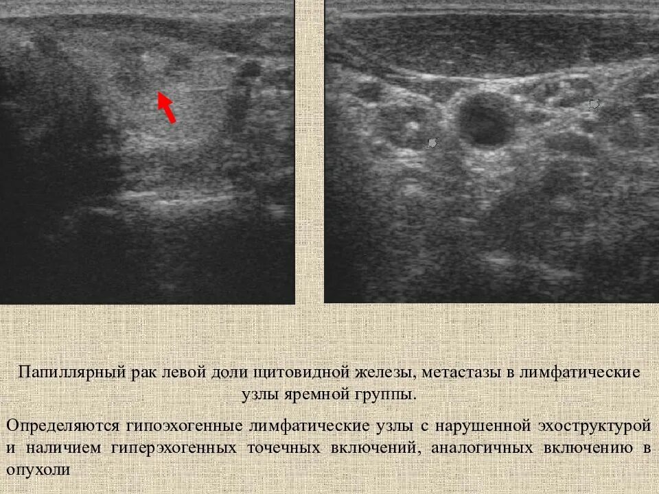 Метастазы при раке щитовидной железы. Карцинома щитовидной железы УЗИ. Фолликулярные узлы щитовидной железы УЗИ. Лимфатический узел щитовидной железы УЗИ. Губчатый узел щитовидной железы на УЗИ.