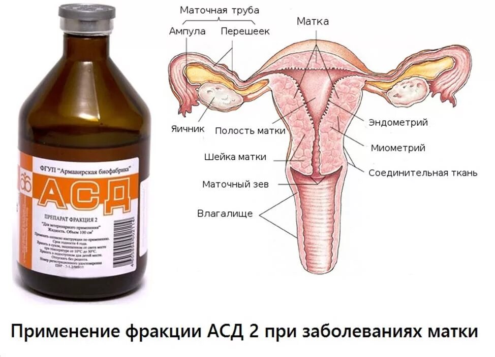 Фракция 2 при гинекологии. Асд2 для человека при кисте яичника. Миома асд 2