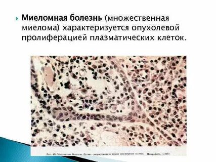 Миеломная болезнь что это за болезнь