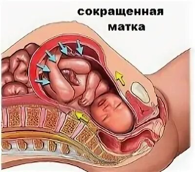 Почему матка приходит в тонус. Тонус матки при беременности. матка в гипертонусе при беременности. гипер тонус в матке при беременности. нормальный тонус матки при беременности.