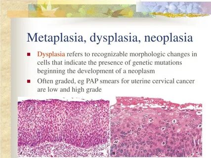 Low grade dysplasia
