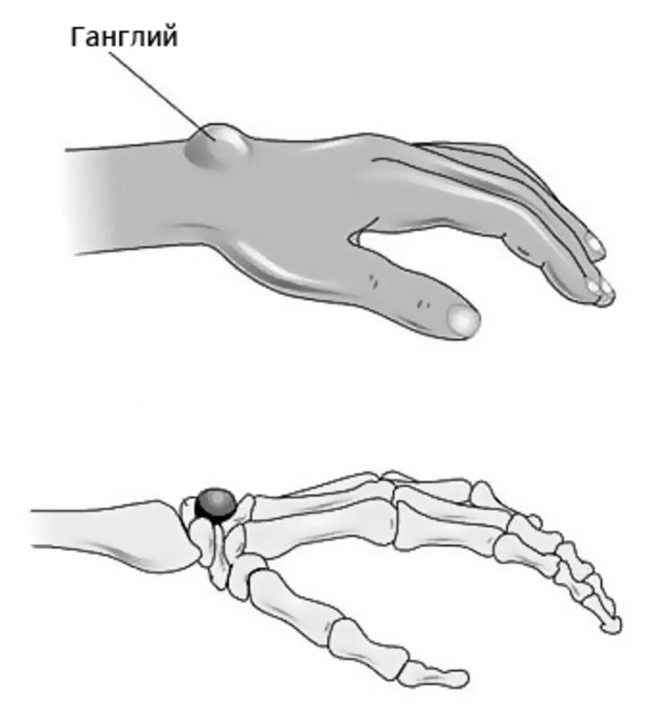 Гигрома запястья (лучезапястного сустава). Гигрома (ганглий) лучезапястного сустава. Гигрома запястно-пястного сустава. Гигрома пястно-фалангового сустава. Почему кости торчат