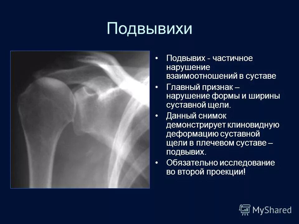 Подвывих плечевого сустава. Подвывих это. Вывих головки плечевого сустава. Травматический вывих надколенника. Подвывих это.
