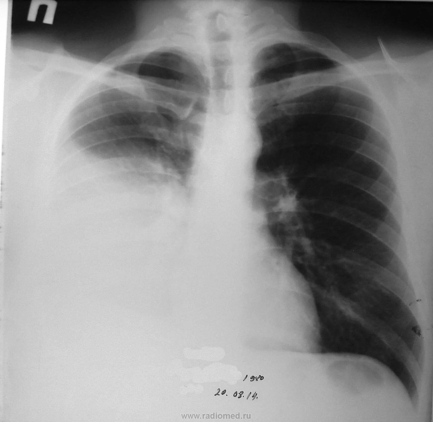 Субтотальная пневмония рентген. Рентгенограмма субтотальной пневмонии. Субтотальное затемнение пневмония рентген. Тотальная и субтотальная пневмония.