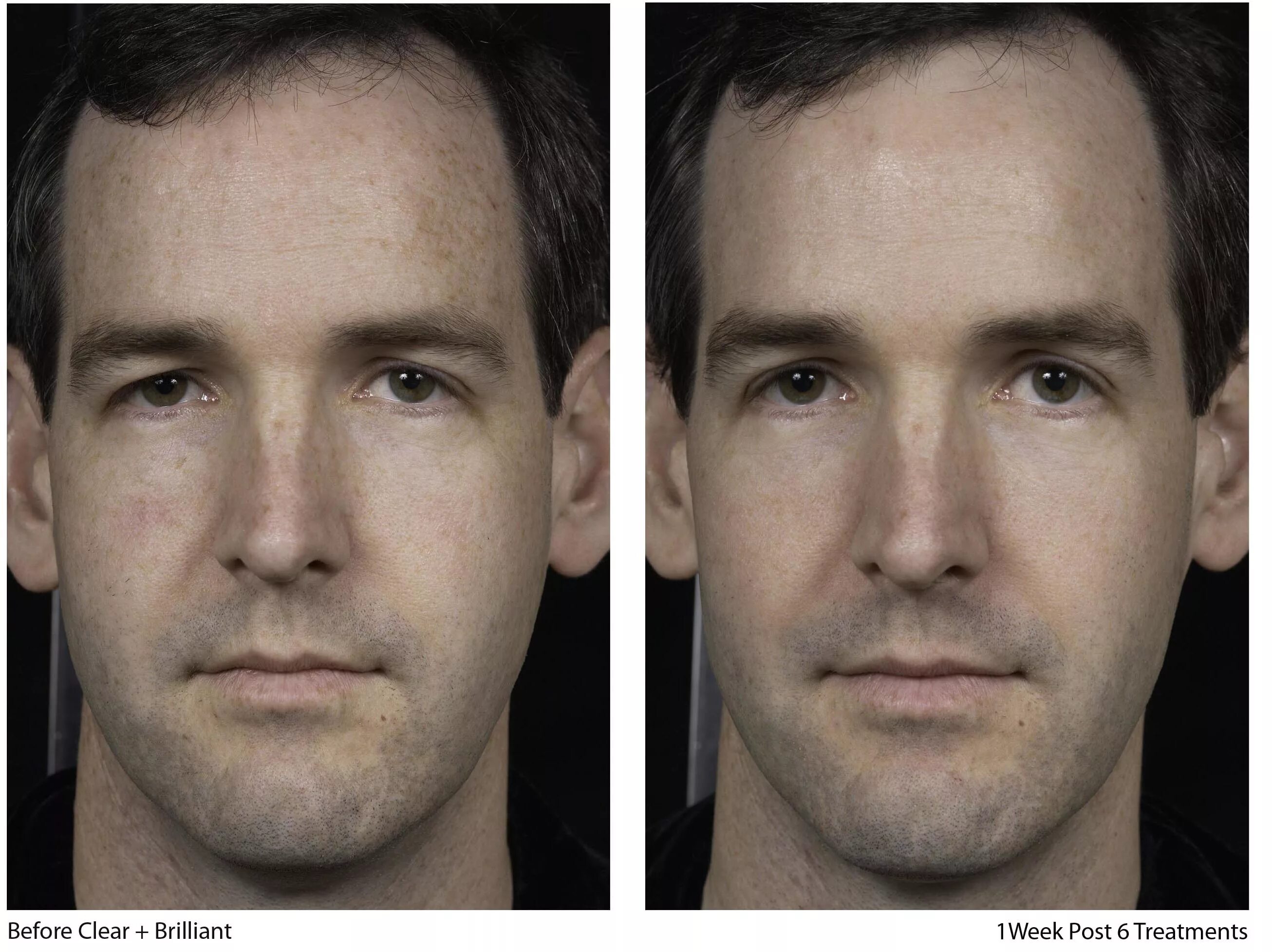 С какого возраста лица мужского пола. Лазерная шлифовка лица мужчин. Лазерный пилинг до и после у мужчин. Лазерная шлифовка до и после мужчины.