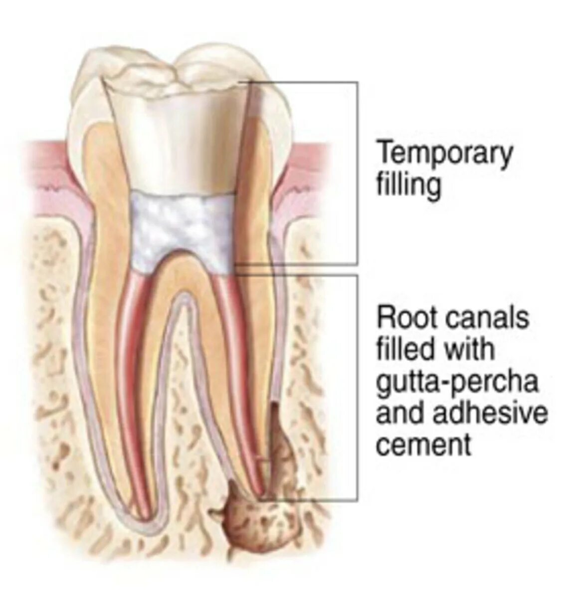 Root canal. Надкостница челюсти анатомия. Периодонтит под пломбой. Периодонтит в запломбированном зубе.