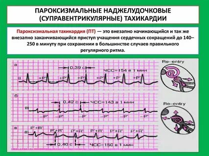 Сколько живут с тахикардией