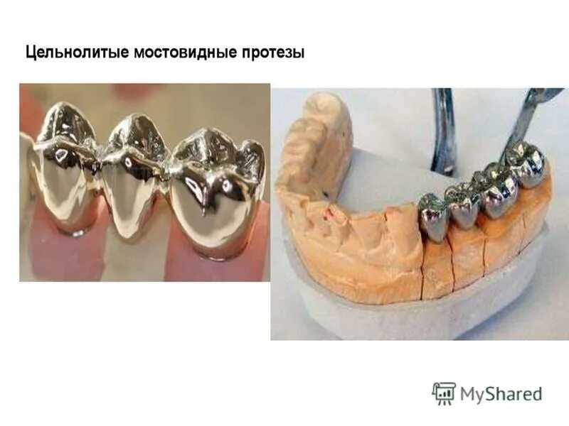 Паяные мостовидные протезы. Припасовка и наложение. Этапы изготовления мостовидных протезов. Этапы изготовления паяных мостовидных протезов. Клинико-лабораторные этапы протезирования мостовидными протезами.
