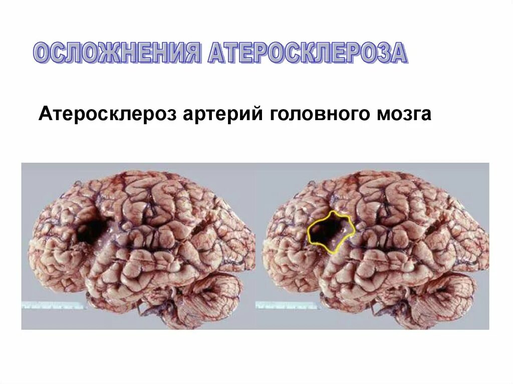 Бляшка в головном мозге. Атеросклероз сосудов головного мозга. Атеросклероз артерий головного мозга. Атеросклероз головного мозга осложнения. Атеросклеротическое поражение сосудов головного мозга.
