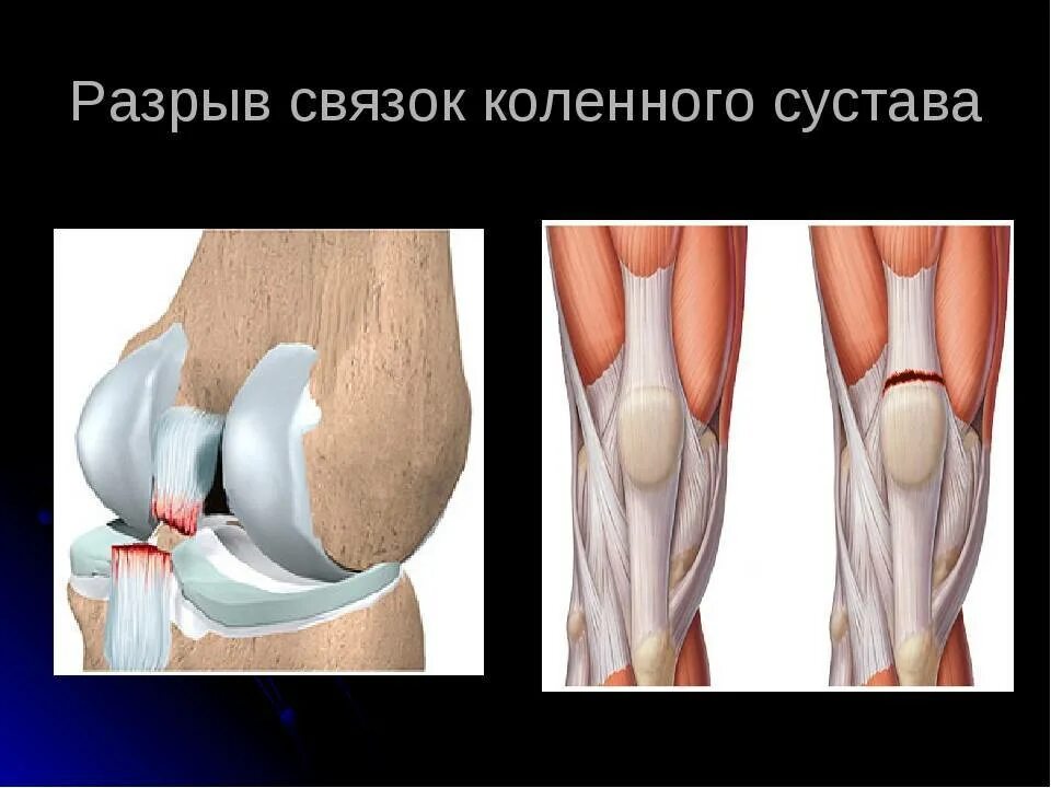 Перерастяжение связок коленного сустава. Растяжение надрыв связок колена. Симптомы повреждения коленных связок. Разрыв сухожилия коленного сустава.