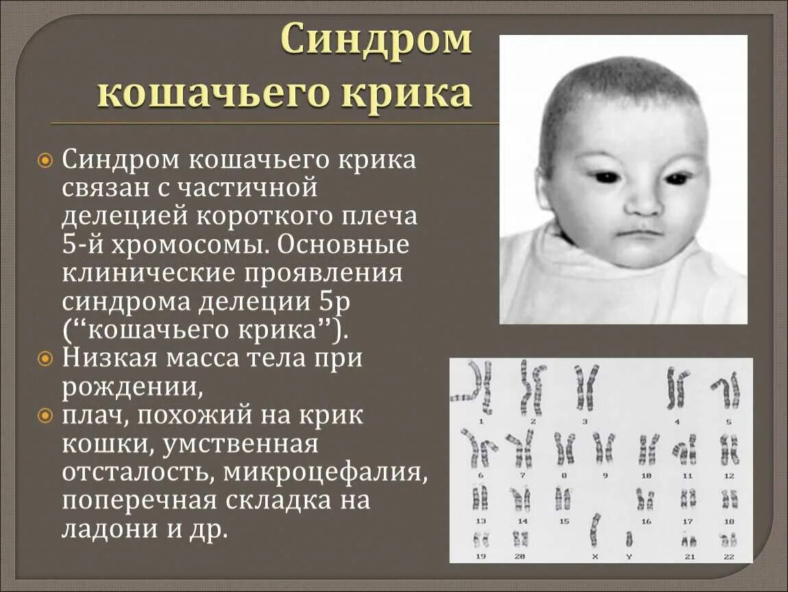 Что такое синдром крика. Синдром кошачьего крика (моносомия 5р). делеция 5 хромосомы синдром кошачьего крика. синдром кошачьего крика кариограмма. синдром кошачьего крика (делеция в 5-ой хромосоме);.