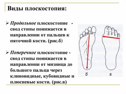 Плоскостопие признаки симптомы