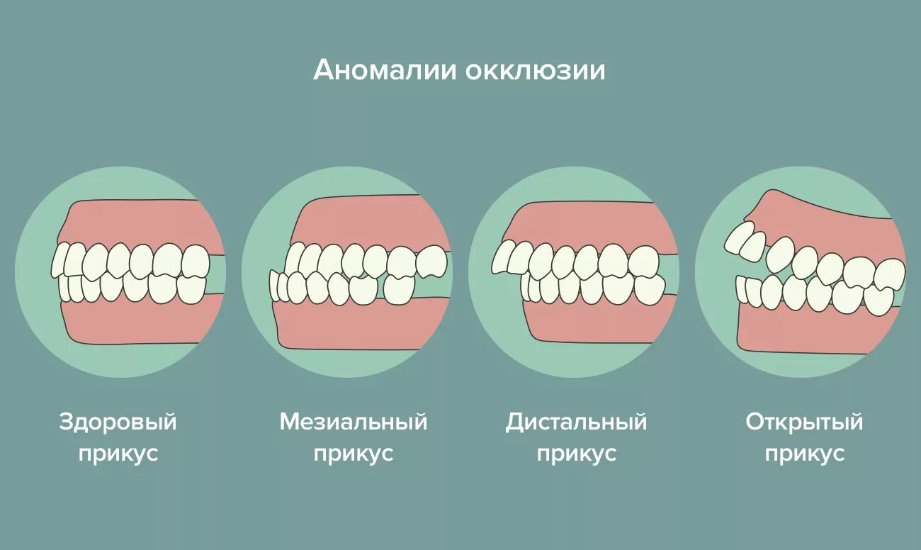 Исправляем форму десен. Правильный прикус у человека схема сбоку. Правильный прикус зубов у человека схема. Как выглядит неправильный прикус прикус зубов. Правильный и неправильный прикус зубов как выглядит.