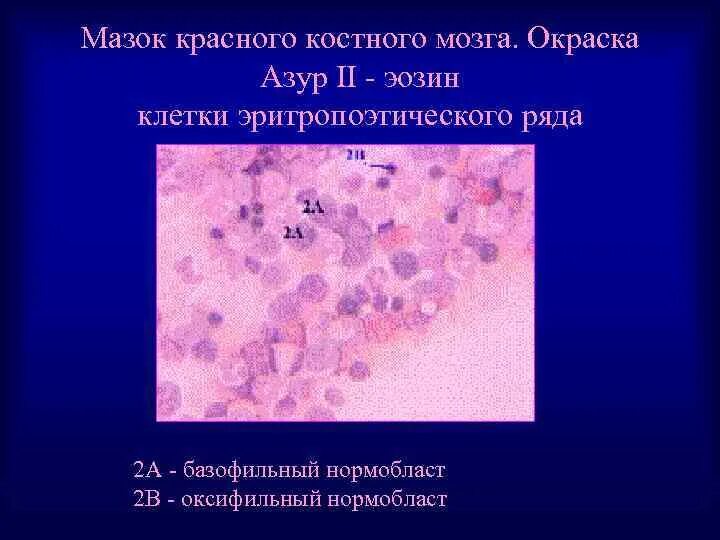 Метод пунктатов красного костного мозга. Картина крови при миеломной болезни. Ретикулярные клетки красного костного мозга. Красный костный мозг мазок гистология. Мазок красного костного мозга азур 2 эозин.