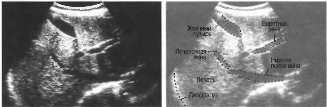 Печень анатомия печеночная вена. Извитость печеночных вен. Воротная вена анатомия схема. Нижняя полая вена и печень. Воротная вена печени на узи.