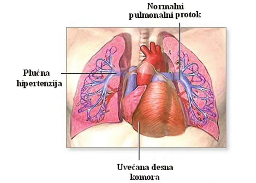 Гипертрофия правого желудочка рентген. Признаки ремоделирования миокарда. Переднеперегородочный инфаркт миокарда на экг. Гипертрофия левого желудочка на рентгенограмме. Легочное сердце на рентгенограмме.