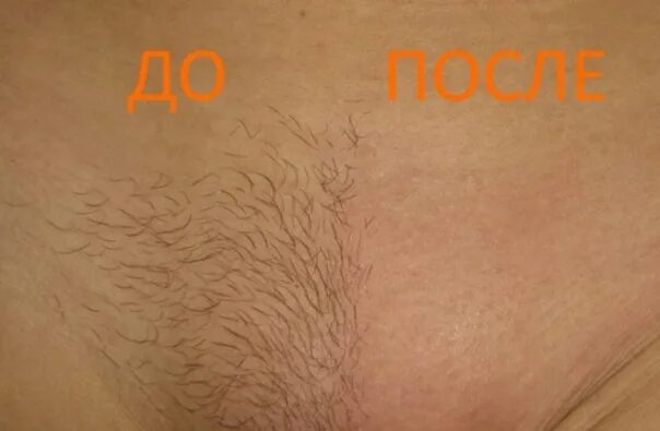 Надо Ли Брить Член