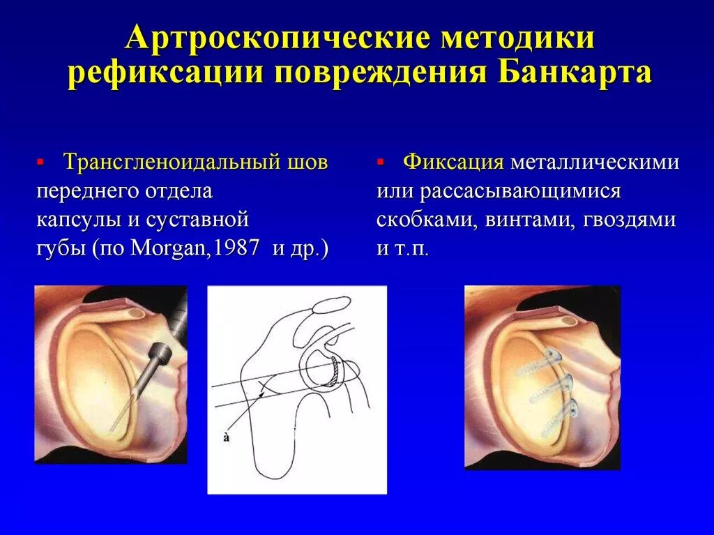 Повреждение губы плечевого сустава. Повреждение Банкарта плечевого сустава. Привычный вывих Банкарта. Артроскопический шов повреждения Банкарта. Артроскопическая фиксация передней суставной губы.