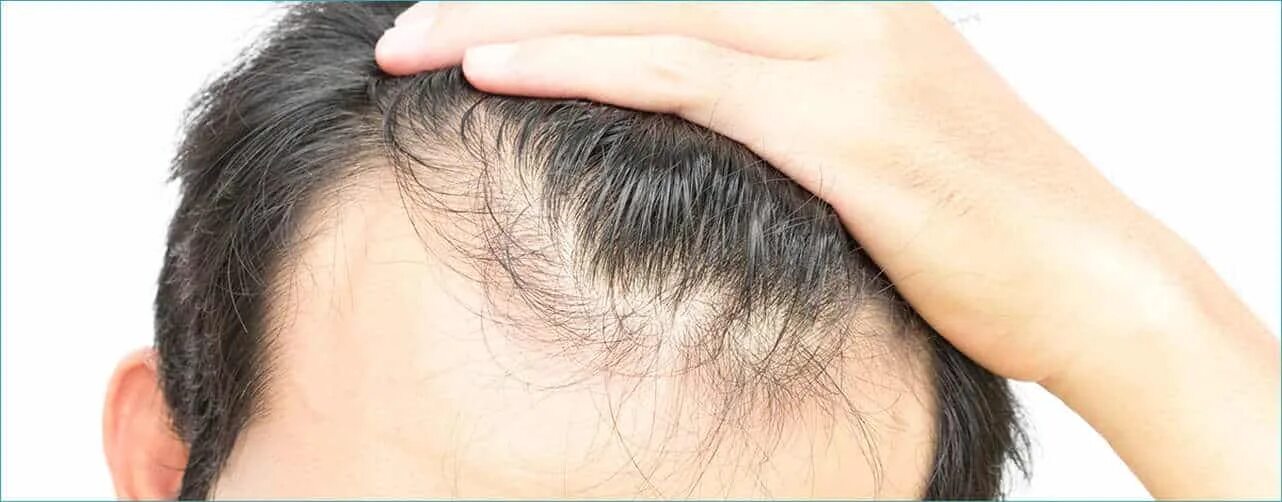 Выпадение волос у мужчин лечение