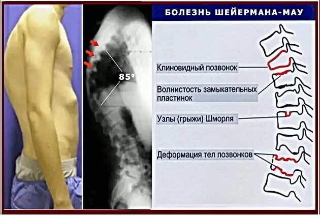 Болезнь шейермана мау что это такое. Остеохондропатия позвонков болезнь Шейермана-МАУ. Остеохондропатия Шойерман МАУ. Остеохондропатия болезнь Шейермана МАУ. Кифоз болезнь Шейермана-МАУ.