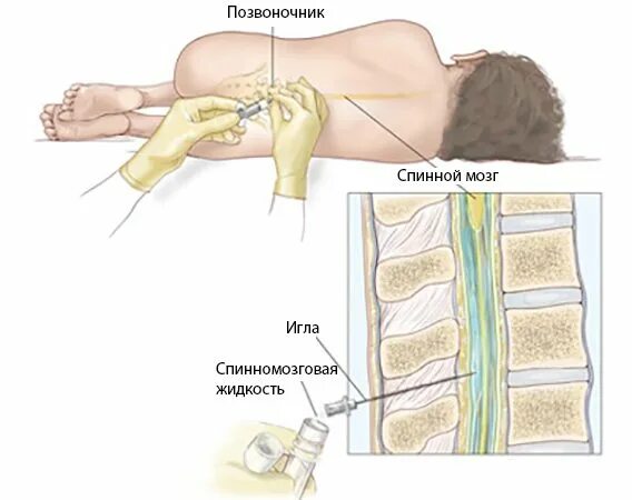 Сколько делают пункцию. Ликвор спинномозговая пункция. Ликвор СМЖ. Люмбальная спинномозговая пункция. Люмбальная пункция ликвора.