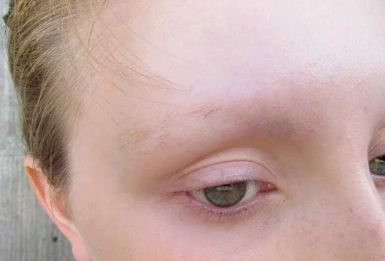 Редкие брови. Выпали ресницы после перманентного макияжа. Выпала бровь у ребенка. Трихотилломания ресницы и брови. Человек без бровей и ресниц.