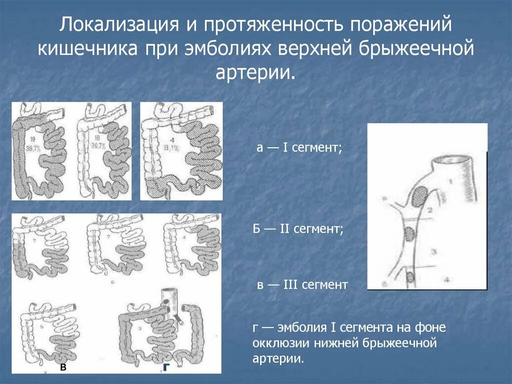 Острое мезентериальное кровообращение. Мезентериальный тромбоз патанатомия. Деление верхней брыжеечной артерии. Локализация эмболов в стволе верхней брыжеечной артерии. Локализация верхней брыжеечной артерии.