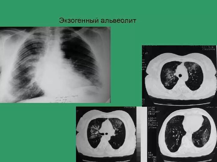 Альвеолиты рекомендации. Экзогенный аллергический альвеолит кт. Экзогенный аллергический альвеолит рентген. Гиперчувствительный пневмонит кт. Фиброзирующий альвеолит на кт.