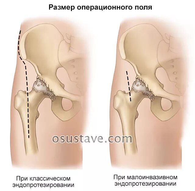 Где сделать операцию на сустав. Операция эндопротез тазобедренный. эндопротезирование тазобедренного сустава техника операции. малоинвазивное эндопротезирование тазобедренного сустава. разрез при эндопротезировании тазобедренного сустава.