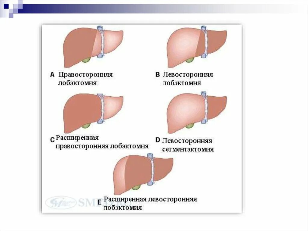 Операция по удалению печени