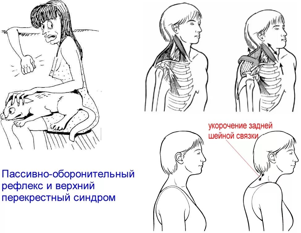 Тонус грудной мышцы. Тонус грудной мышцы. Верхний и нижний перекрестный синдром. Для повышения тонуса скелетных мышц. Мышцы спины человека.