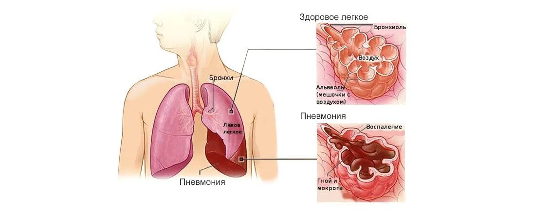 Заболевания дыхательной системы пневмония. Заболевание легких пневмония. Пневмония это острое инфекционное заболевание.