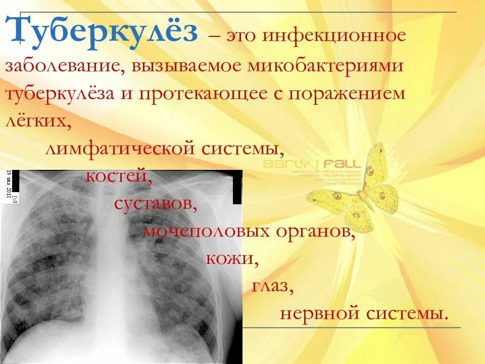 Туберкулез tuberculosis. Туберкулез презентация. Туберкулёз презинтация. Презентация по туберкулезу. Tuberkulyoza.