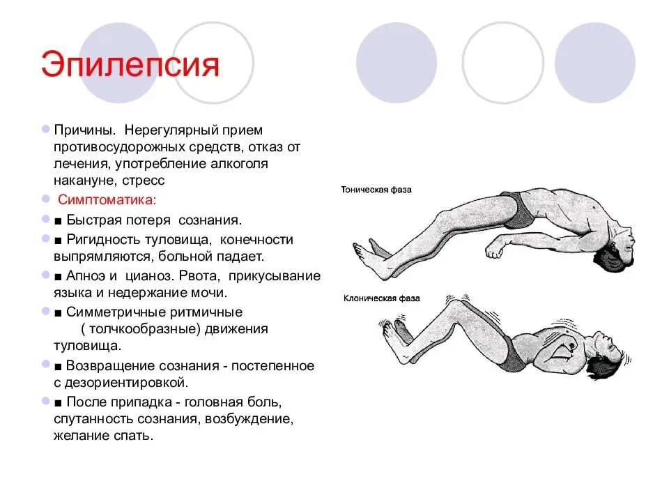 Повторяются приступы эпилепсии. Эпилепсия клиника фазы. эпилепсия причины симптомы. приступ эпилепсии причины возникновения. предпосылки приступа эпилепсии.