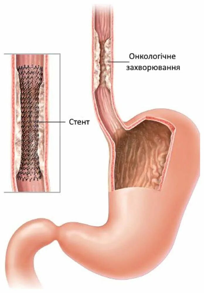Раздраженный пищевод. Стентирование пищевода. Эндоскопическое стентирование пищевода. Стентирование кишечника. Стентирование опухоли желудка.