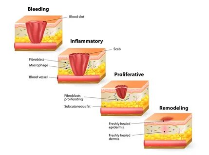 Wound healing