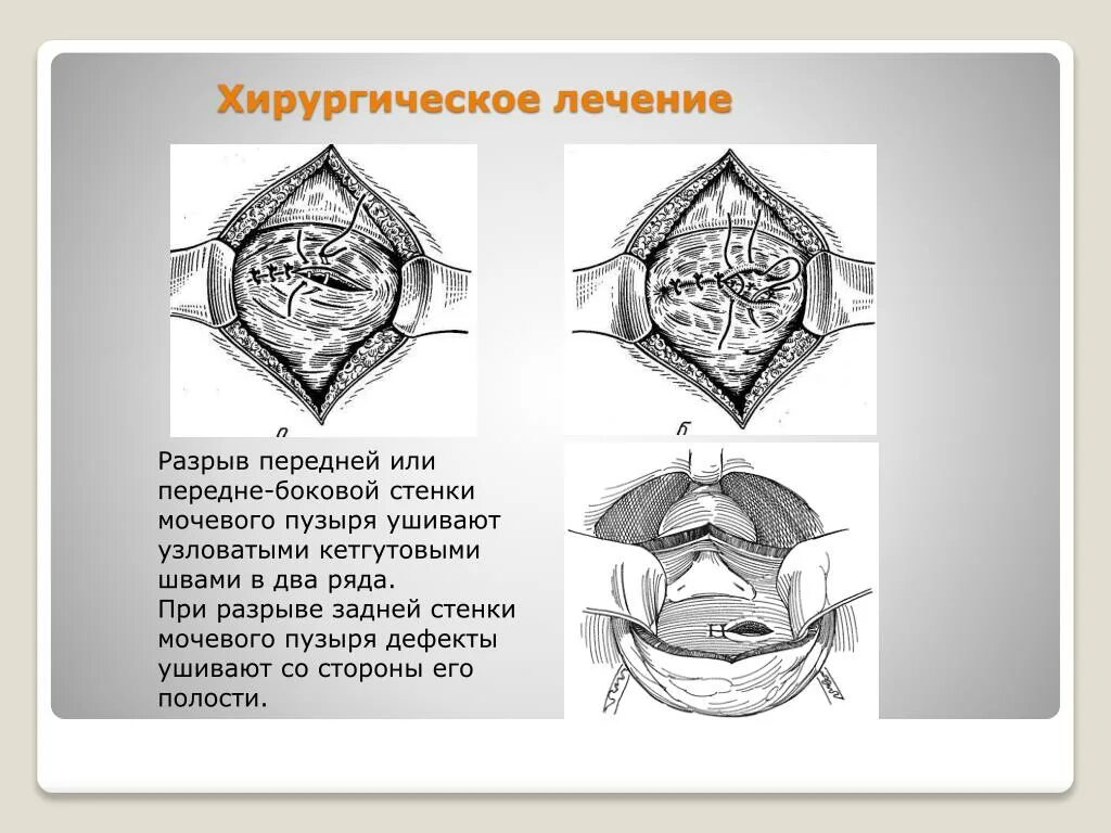 Внутрибрюшинный разрыв. Операция при внутрибрюшинном ранениях мочевого пузыря. Оперативное лечение ранений мочевого пузыря. Операция при разрыве мочевого пузыря. Ушивание разрыва мочевого пузыря.