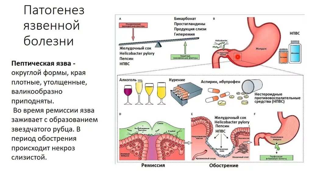 Роль гастрита. Этиология язвенной болезни желудка. Патогенез язвы желудка и двенадцатиперстной кишки. Язвенная болезнь этиология и патогенез. Патогенез язвенной болезни двенадцатиперстной.