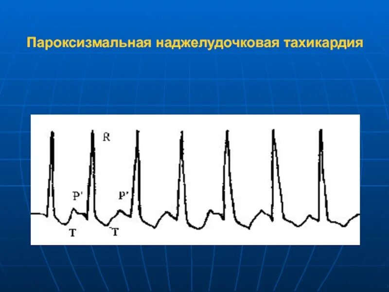 Приступ наджелудочковой тахикардии. Приступ наджелудочковой тахикардии. Лечение пароксизмальной наджелудочковой тахикардии. Параксизмальная надделкдлчковач тахикардияэкг. Симптомы наджелудочковой тахикардии.
