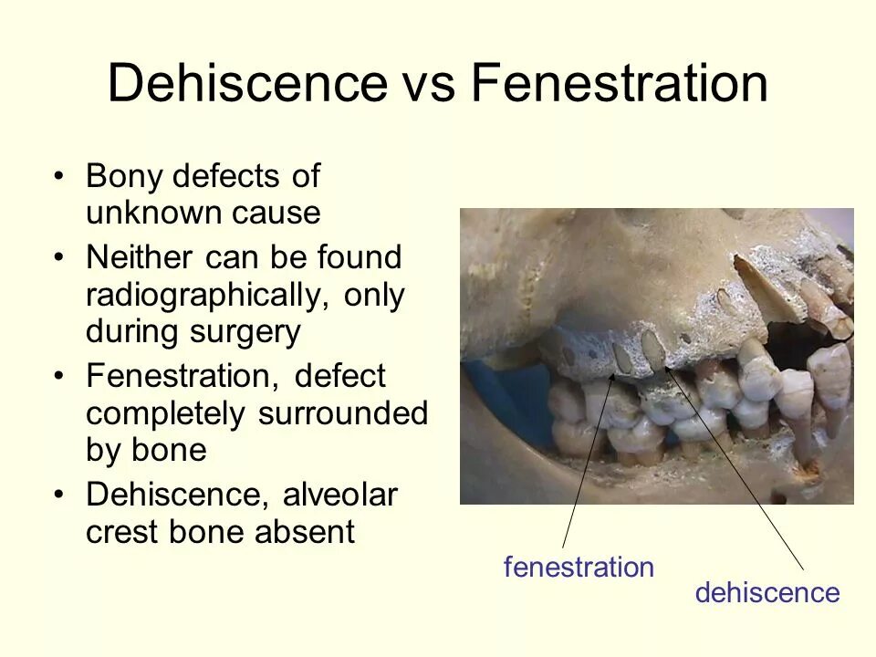 Unknown cause. Дегисценция и фенестрация. Фенестрация и дегисценция зуба.
