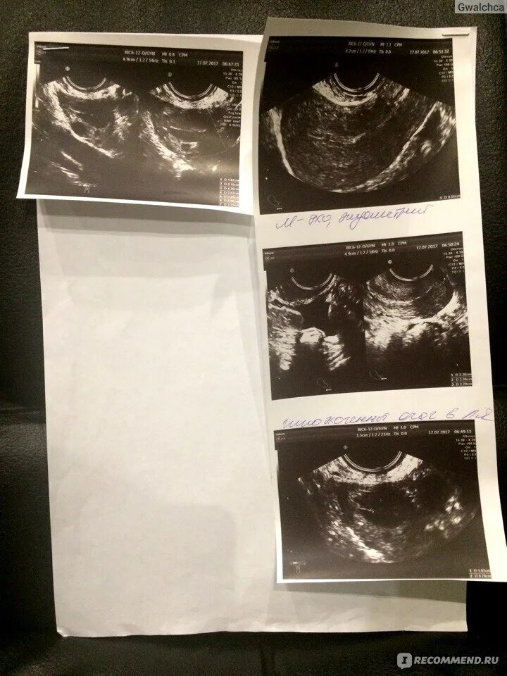 Вирсунгов проток поджелудочной железы узи. Расширение вирсунгова протока на узи. Трубы не визуализируются что это значит. Парапанкреатический инфильтрат поджелудочной железы на узи. Узи почек и надпочечников протокол.