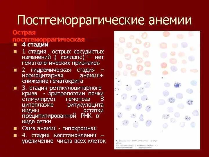 Анемия в моче. Постгеморрагическая анемия анализ крови. Острая постгеморрагическая анемия картина крови. Хроническая постгеморрагическая анемия анализ крови показатели. ОАК при острой постгеморрагической анемии.